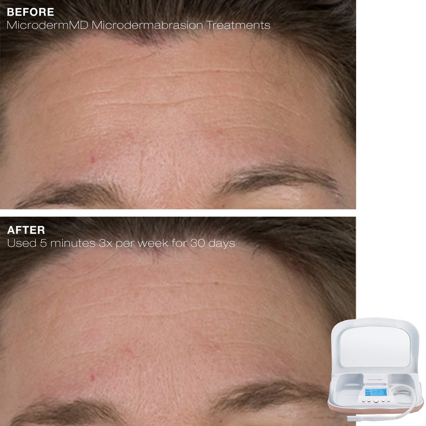 Trophy Skin MicrodermMD - At Home Microdermabrasion Kit - Anti Aging and Acne Treatment - Contains Real Diamond and Pore Extractor Tips to Rejuvenate Skin and Reduce Acne Scars